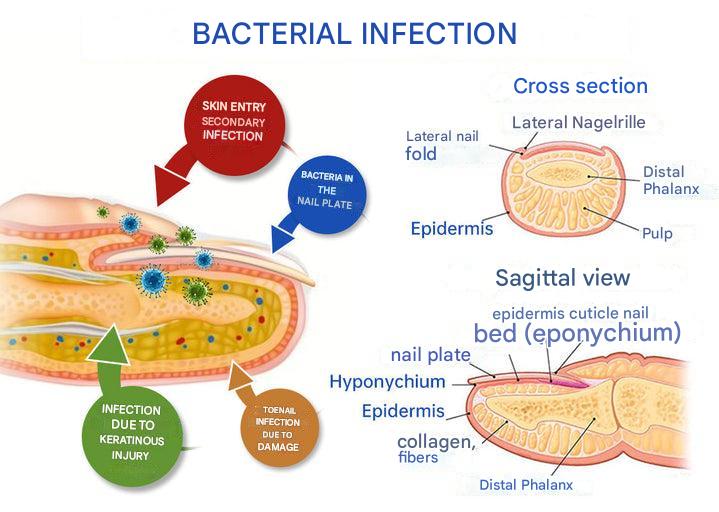 ClearZap™ Zařízení pro světelnou terapii plísní | Rychlé, účinné a bezbolestné řešení!