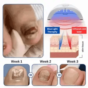 ClearZap™ Zařízení pro světelnou terapii plísní | Rychlé, účinné a bezbolestné řešení!