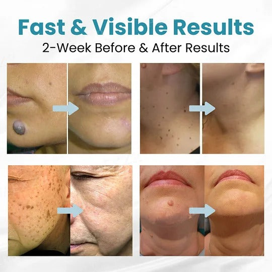 HOOMWELL™ Neinvazivní laserové pero na odstranění mateřských znamének a bradavic