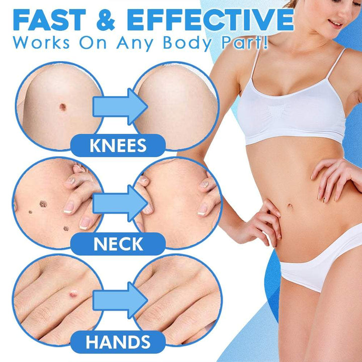 TagAway™ Sada pro pokročilé odstraňování kožních výrostků