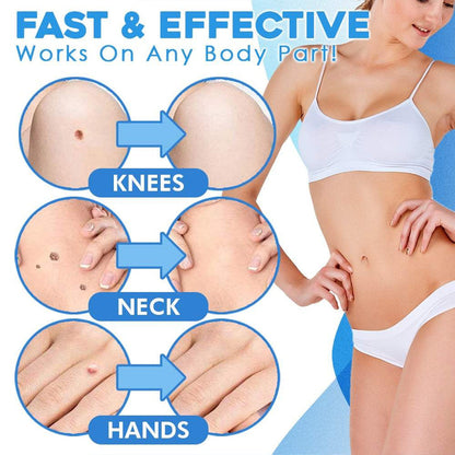 TagAway™ Sada pro pokročilé odstraňování kožních výrostků